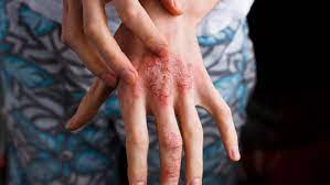 Atopic Dermatitis