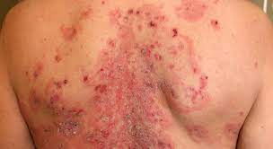 Pemphigus.