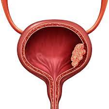 bladder.jpeg