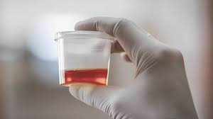 blood-in-urine.jpeg