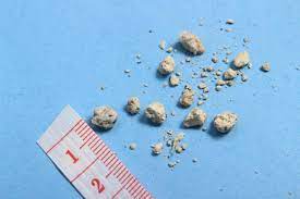 kidney-stone.jpeg