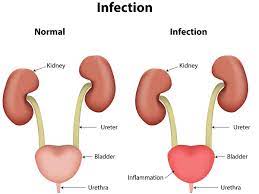 urinary-tract-infection.jpeg