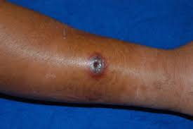 Cutaneous anthrax