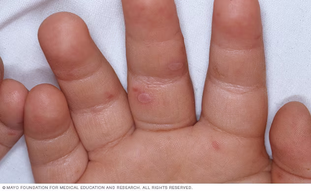 Hand foot and mouth disease