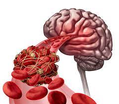 Ischemic stroke