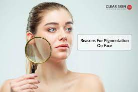 Pigmentation disorders