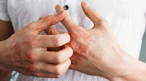 Raw, sensitive skin from scratching